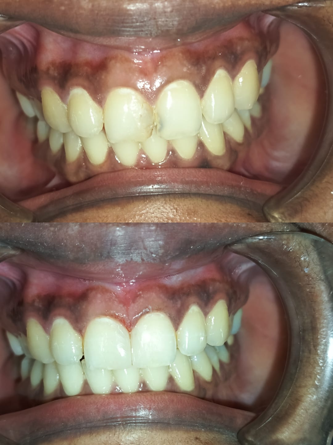 Closing gap with tooth coloured filling